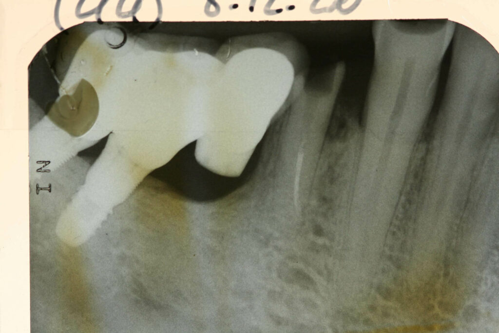 Implant court et hygiène maitrisée