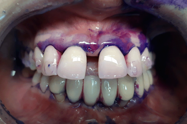 Coloration du biofilm phloxine b gencibrosse debut de la seance maintenance