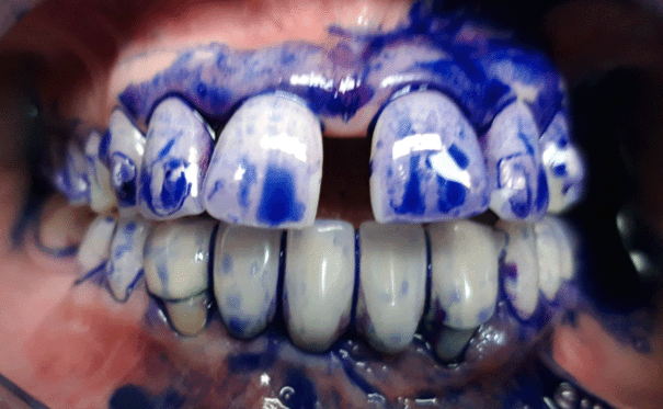 Coloration du biofilm phloxine b