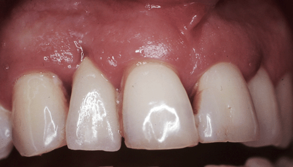 Péri-implantite maintenance implantologie